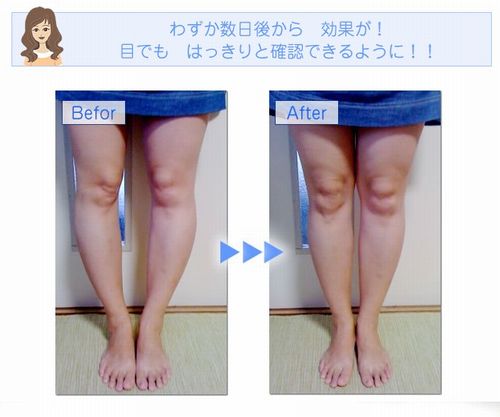 膝下 ｏ脚の治し方